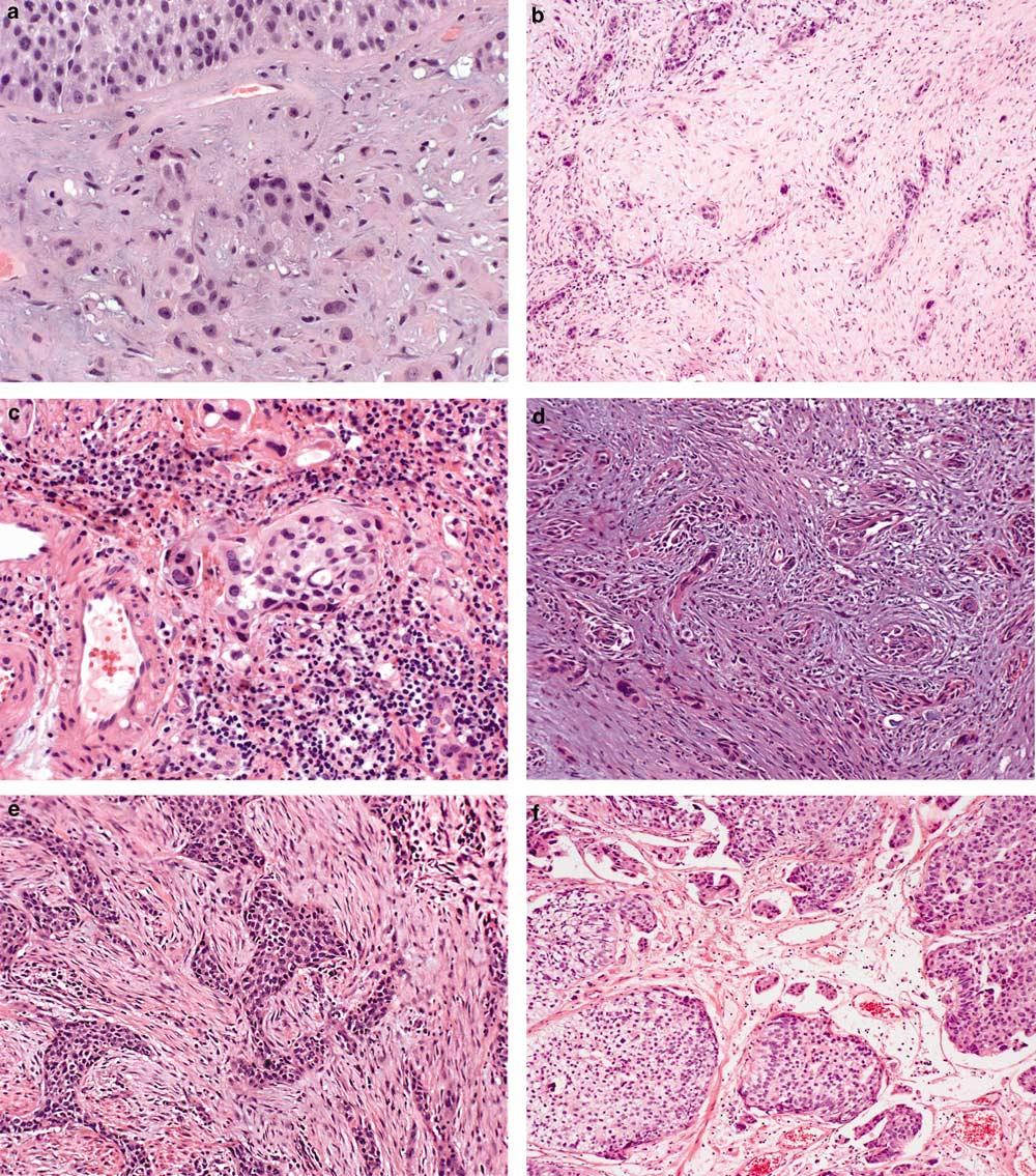 S75 Figure 7 Stromal responses in invasive urothelial carcinoma. The stromal reaction to invasive tumor may be (a) myxoid; (b) fibrous; (c) inflammatory; (d) pseudosarcomatous; or (e) desmoplastic.