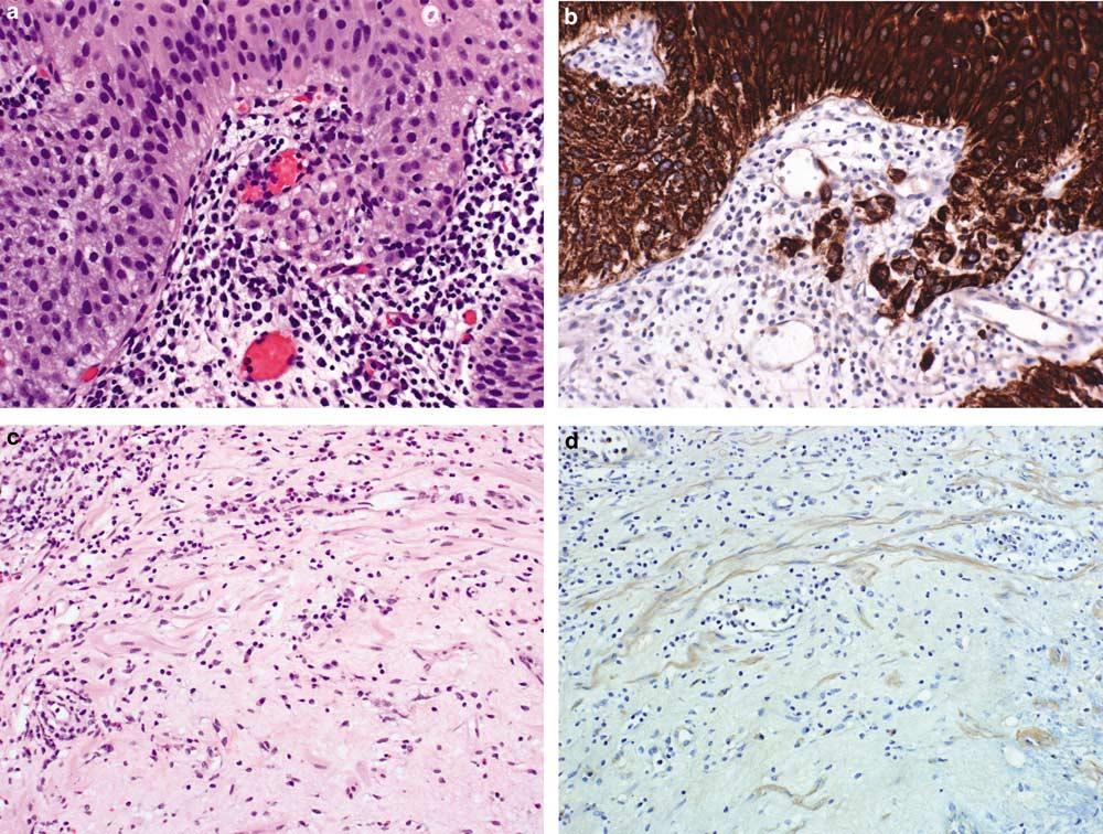 S76 Figure 8 (a) Prominent inflammation at the epithelial stromal interface may obscure isolated cells or small nests of invasive carcinoma.