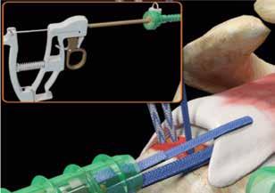 Close the jaws of the TRUEPASS Suture Passer and withdraw the device out of the lateral portal.