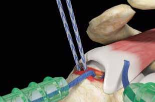Shuttle suture limb to the anterior portal. 8.