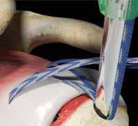 Knotless Suture Anchor through the lateral portal taking care not to twist the sutures. a.