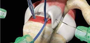 or in the upper jaw). d. Close the jaws of the TRUEPASS Suture Passer and withdraw the device out of the lateral portal.