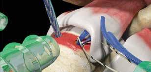 Using the suture loop grasper, shuttle the passed limb of ULTRABRAID Suture to the anterior portal. 7.