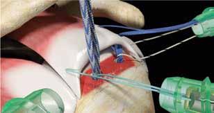 Suture Passing (Posterior Medial Anchor) 10. Using a suture loop grasper through the lateral portal, retrieve one limb of ULTRABRAID suture from the posterior medial anchor. 11.