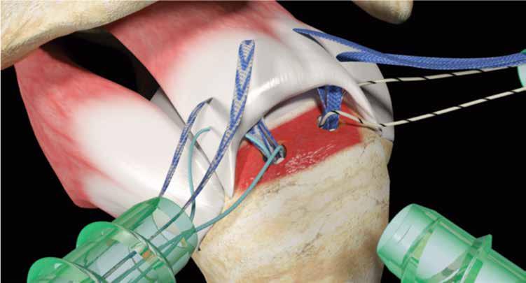 Through the lateral portal, retrieve and pass an ULTRATAPE Suture from the posterior medial anchor through the posterior medial aspect of the tendon (slightly more medial to the previously passed