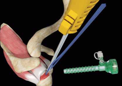 Introduce the FOOTPRINT ULTRA PK Knotless Suture Anchor through the superior lateral portal. a.