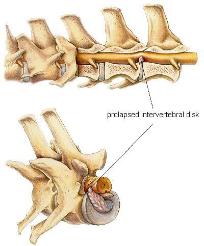 herniated intervertebral disc