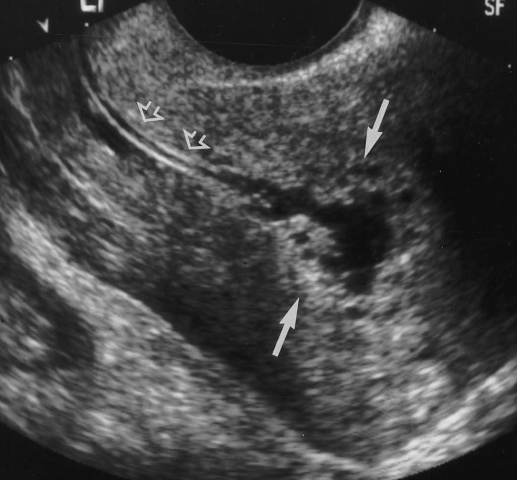 Sonohysterography of the A Fig. 2. 55-year-old woman undergoing tamoxifen treatment for 5 years. A, (calipers) is thickened, with cystic areas on sagittal transvaginal sonogram.