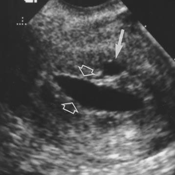 Sonohysterography of the A Fig. 4.