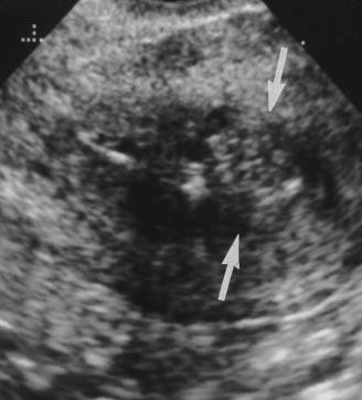cysts. A, (arrows) appeared ill-defined, had cystic areas, and measured 11 mm in thickness on sagittal transvaginal sonogram.