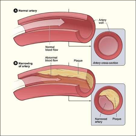 Figure 1.1. A schematic illustration of artery in the healthy and atherosclerotic states[4].