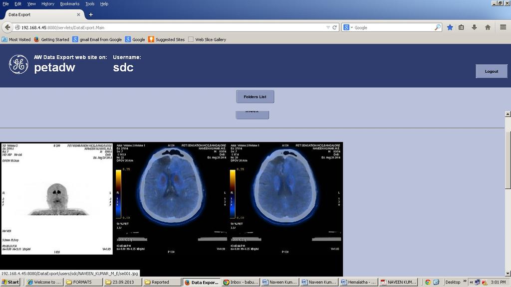 DOPA PSMA MRI FINDINGS- elsewhere Porencephalic cavity in the right frontal lobe involving the