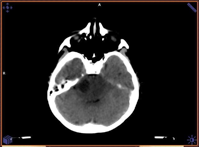 cystic lesion in the brain stem suggestive