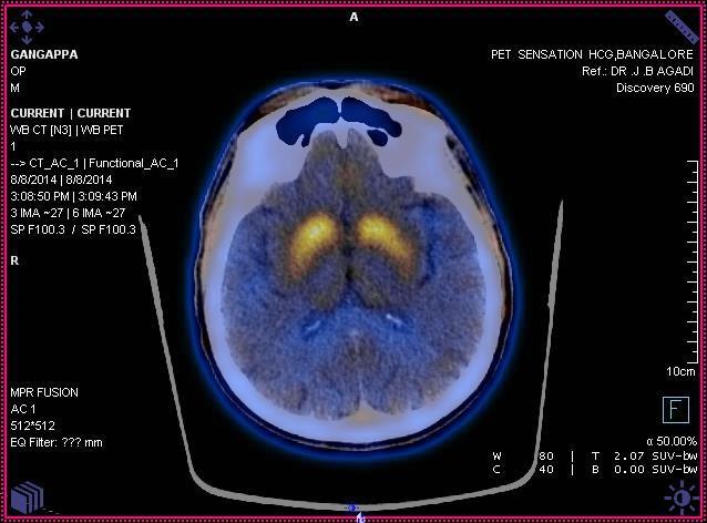 FDOPA SCAN IN EVALUATION FOR PARKINSONISM Normal Control image