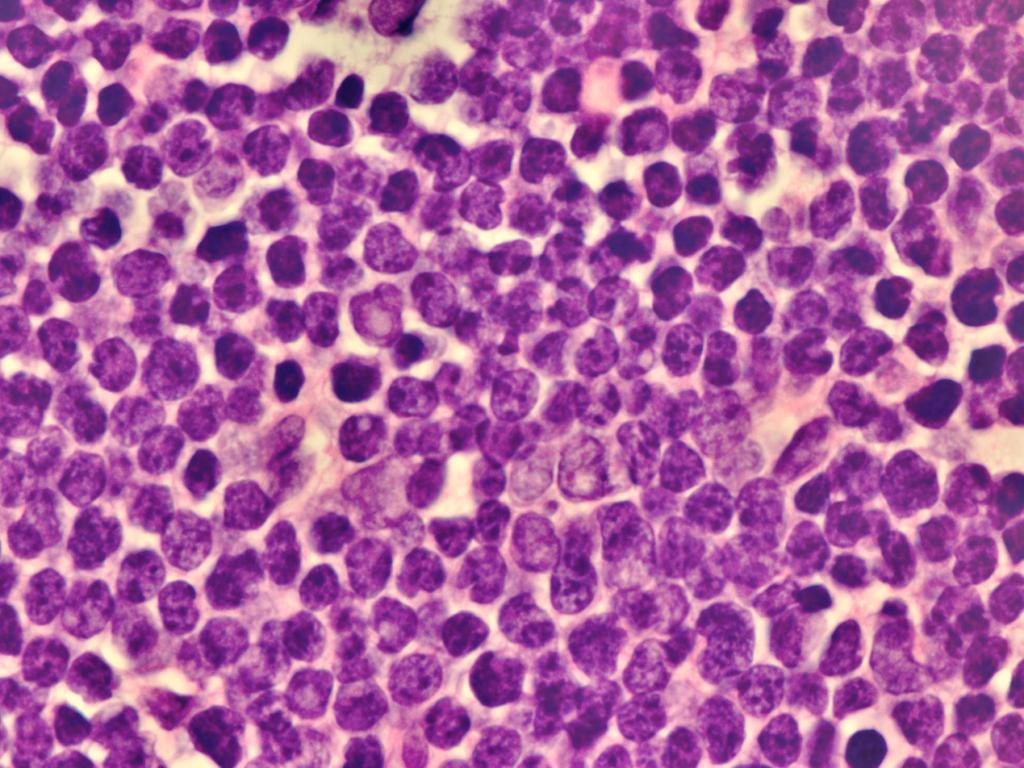 Secondry Precursor T-Cell Lympholstic Lymphom Journl of Cncer Reserch Updtes, 2014, Vol. 3, No.