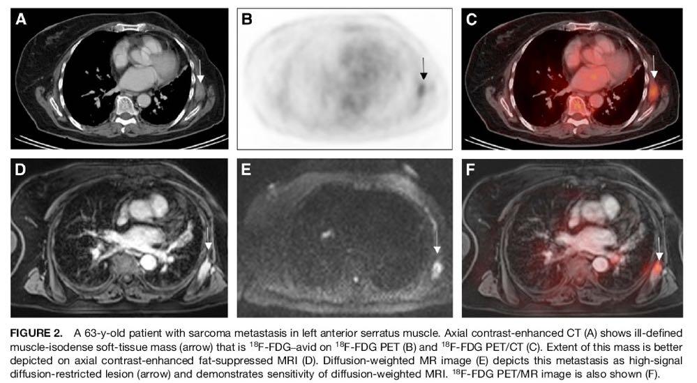 18F-FDG PET does not add information to MRI for T-staging in soft-tissue sarcomas. On the other hand, 18F-FDG PET provides additional prognostic information.