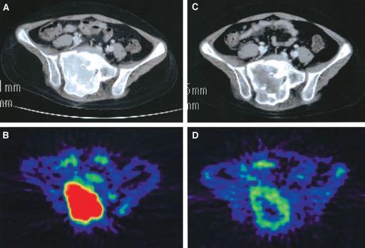 [11C]Methionine Positron Emission Tomography and Survival in Patients with Bone and Soft Tissue Sarcomas Treated by Carbon Ion Radiotherapy (Zhang H et al, Clin Cancer Res, 2004) MET-PET uptake