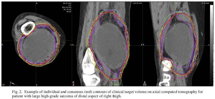 CTV Include gross tumor and clinical microscopic margins (CTV = GTV plus 3-cm margins) in the proximal and distal directions.