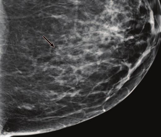 Tomosynthesis in Routine Screening statistically significant, increase in breast cancer detection rates was observed. Recall rates were reduced for all radiologists in the study.