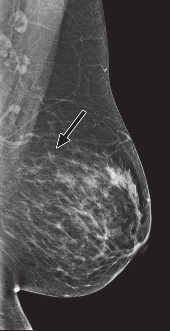 2 Comparison of digital mammography and tomosynthesis images in 42-year-old woman with 10- mm invasive ductal carcinoma in left breast.