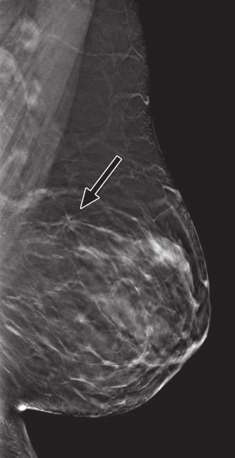Tomosynthesis images show improved visibility of cancer (arrow) and cancer margins compared with digital mammography. chronologically before those with tomosynthesis.