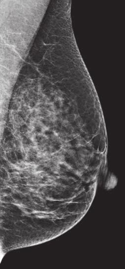 Tomosynthesis images show that structures at different levels in breast can summate to create suspicious region on digital mammography image that may be identified as negative or superimposed tissue