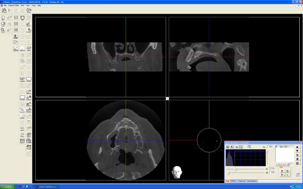 ident Scan Parameters Use the following machine settings: Settings for Patient with Appliance: FOV : 140 x 50 Generator: 90 kvp