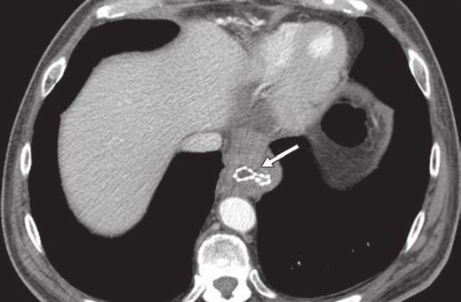 MDCT of iliary and Gastrointestinal Stents Fig.