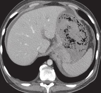 Emergent CT scans were obtained 1 month after cardiac stenting because of