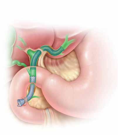 What should I expect during the procedure? Your metal stent will be implanted in the distal region or the hilar region of the bile duct by a doctor who is specially trained in this procedure.