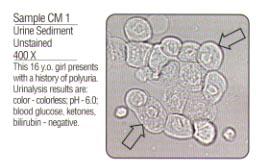 Similar in appearance to renal epithelial cells 2-4 times the size of WBC Few are