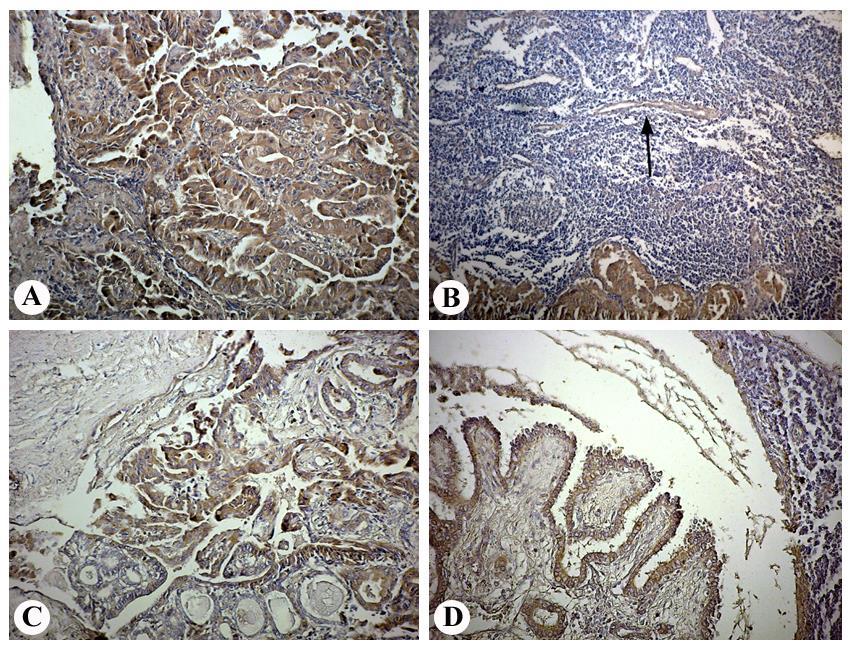 Slika 31. Imunohistohemijska ekspresija VEGF-C u tkivu papilarnog karcinoma i metastatskom tkivu u regionalnom limfnom čvoru istog pacijenta.