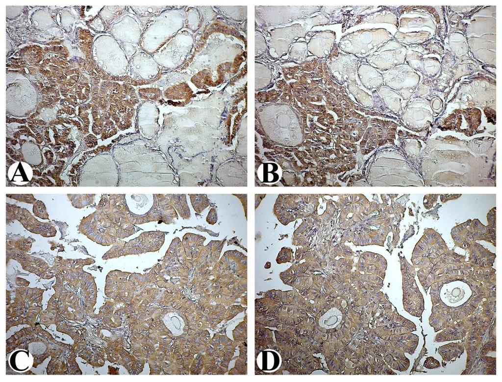 Slika 32. Korelacija imunohistohemijske ekspresije survivina i VEGF-C u papilarnom karcinomu štitaste žlezde.