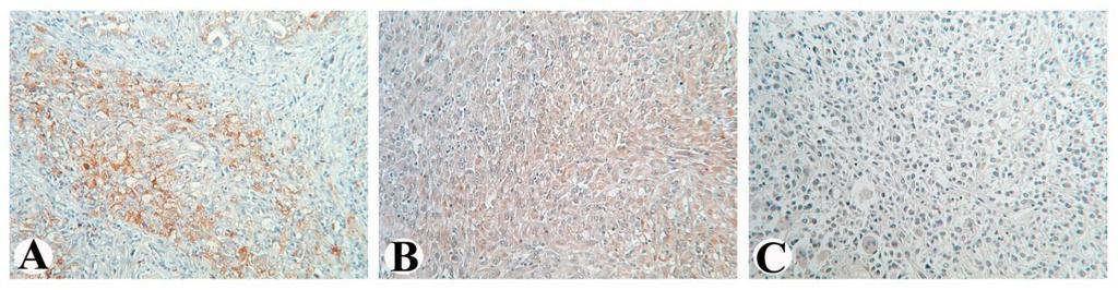 Slika 15. Imunohistohemijska ekspresija Bcl-2 u uzorcima tkiva anaplastičnog karcinoma štitaste žlezde. Fokalno bojenje (A), bojenje slabog intenziteta (B), odsustvo imunohistohemijskog bojenja, tj.