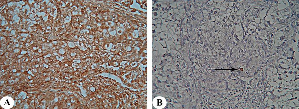 Slika 24. Anaplastični karcinom sa intenzivnim imunohistohemijskim bojenjem na survivin (A) i detekcija in situ apoptotske smrti samo u jednoj ćeliji u istoj zoni tkivnog uzorka karcinoma (B).