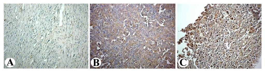 Slika 29. Imunohistohemijska ekspresija VEGF-C u anaplastičnom karcinomu štitaste žlezde. A) Negativna ekspresija VEGF-C (odsustvo imunohistohemijskog bojenja).
