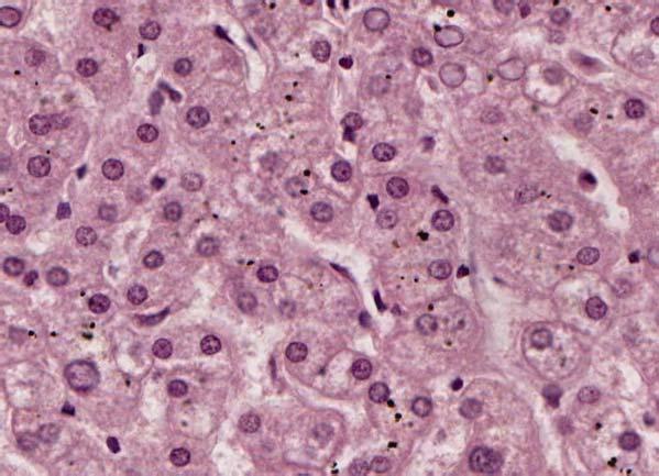 Slide 141: Liver, H&E hepatic sinusoids hepatocyte with a large, spherical nucleus (can be bi-nucleated) and prominent nucleolus; the cytoplasm is generally eosinophilic but mottled hepatocytes are