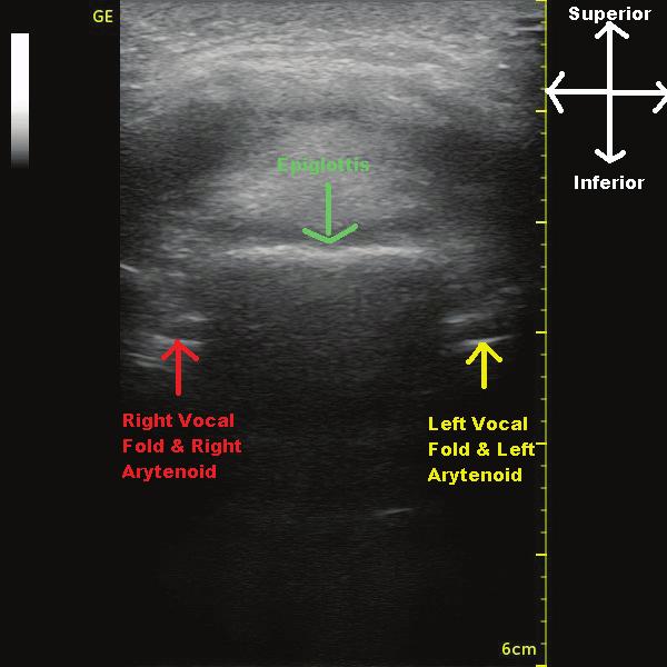 Ultrasound assessment of Vocal Fold Paresis: A Correlation Case Series with Flexible Fiberoptic Laryngoscopy and Adding the Third Dimension (3-D) to Vocal Fold Mobility Assessment 495 Fig.