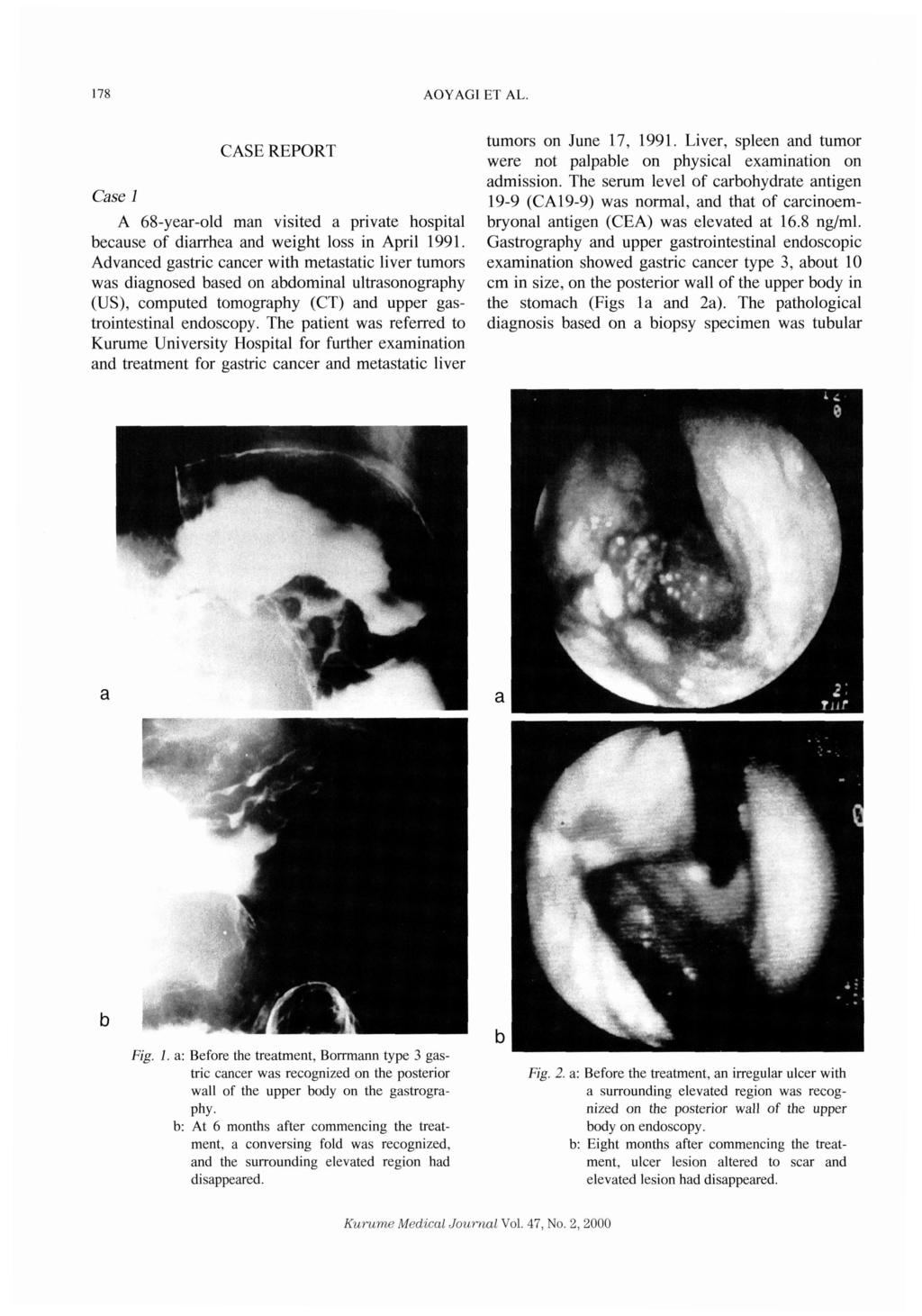 178 AOYAGI CASE REPORT Case 1 A 68-year-old man visited a private hospital because of diarrhea and weight loss in April 1991.