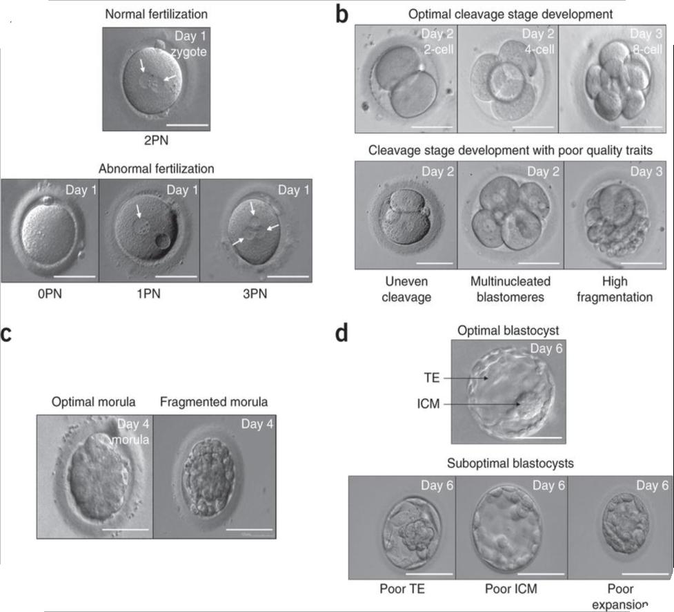 Figure 5 Appearance of normal and abnormal pre-embryo (a) The assessment of normal fertilization on day 1 of embryonic development (day 1 zygote) requires the visualization of two pronuclei (PN), 2PN