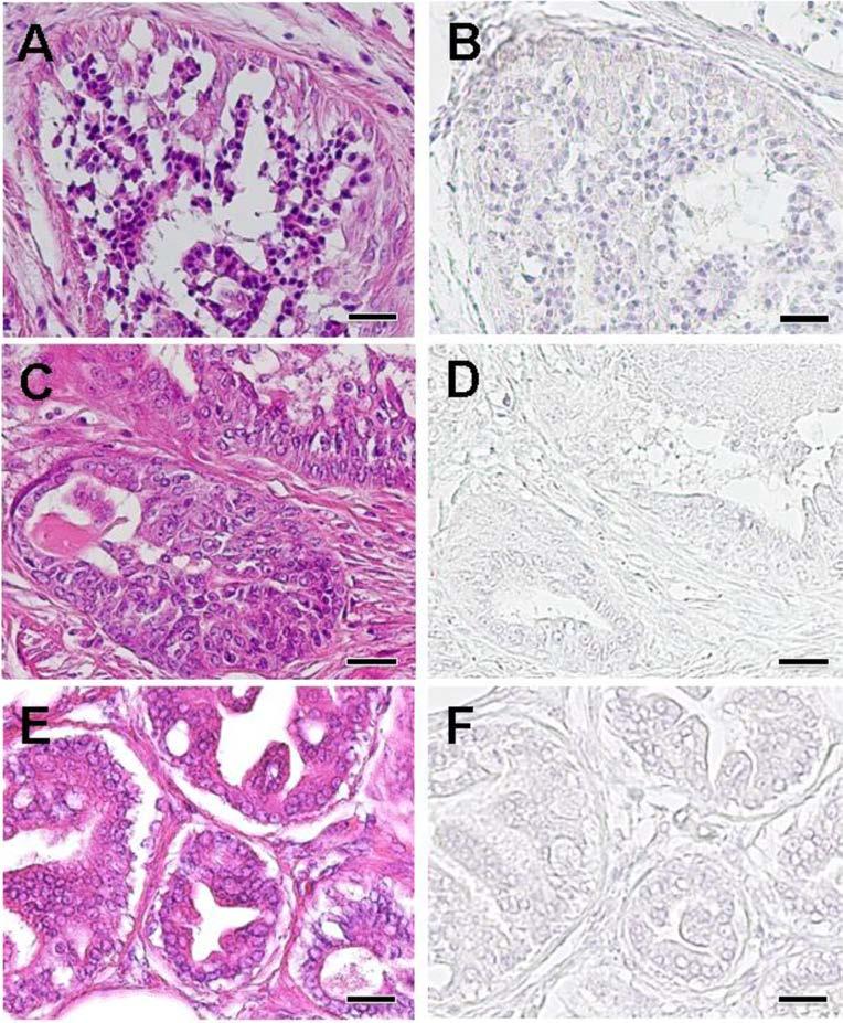 Supplemental Fig. 1. Histological and immunohistochemistrical images of the malignant tumor samples used for Western blotting.