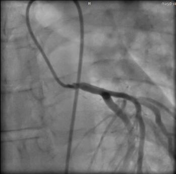 ischemia defer PCI Typical symptoms,