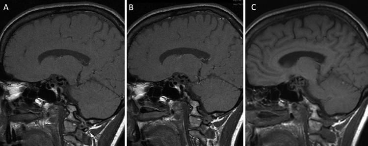 N. McLaughlin et al. referred to our clinic for evaluation of a possible arteriovenous malformation. At age 24, she had undergone brain imaging prompted by the development of more frequent headaches.