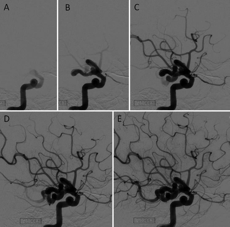 Pure arterial malformation of the posterior cerebral artery Fig. 2. A E: Left ICA injection angiograms, lateral projection, 6-second frame. Images represent sequential frames.
