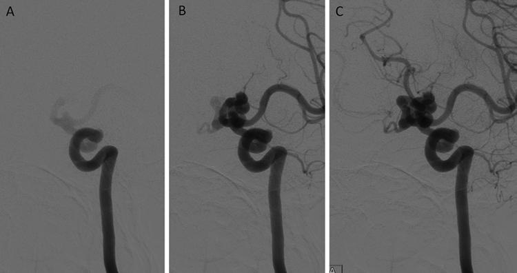 N. McLaughlin et al. Fig. 3. A C: Left ICA angiograms, anteroposterior projection, 6-second frame. Images represent sequential frames. Note the small saccular aneurysm at the origin of the PCoA. (Fig.