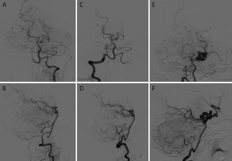 Dysembryogenesis may occur not only in intracranial veins but also in intracranial arteries, which may be linked to structural defects in the arterial wall and migrational abnormalities.