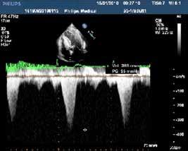 In Panel B, continuous wave Doppler recording at the left ventricular outflow tract demonstrates a peak gradient equal to 55 mmhg.
