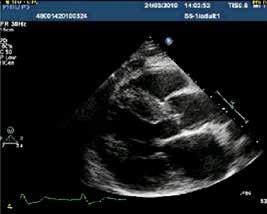 MR due to SAM alone is best treated by septal resection and does not require any additional measures.