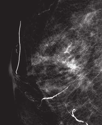 breast in 59-year-old woman show spherical calcified cysts,