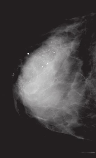 Segmental reast Calcifications Fig. 6 Ductal carcinoma in situ (DCIS).